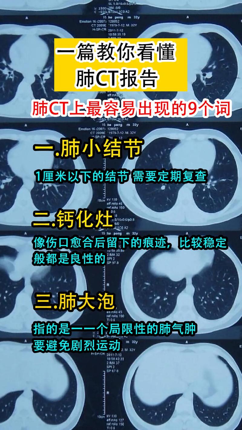 薄层ct能看出肺结节的性质吗
